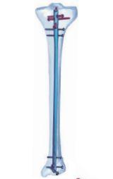 Універсальний великогомілковий стрижень (Double Medical Technology Inc.)